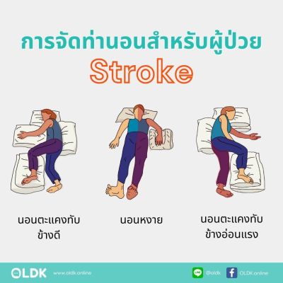 การดูแลผู้ป่วยสโตรก